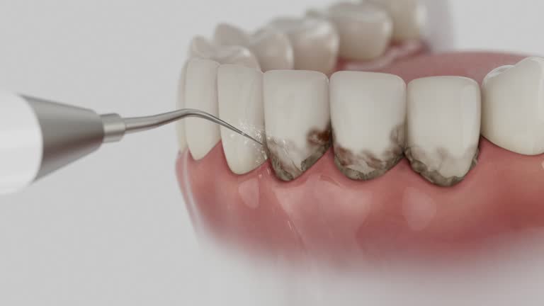 Trusted Wisdom Tooth Removal service in Steelton, PA - Dentist Open Now